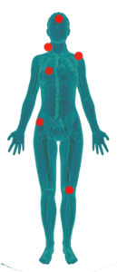 pijnplekken-fibromyalgie